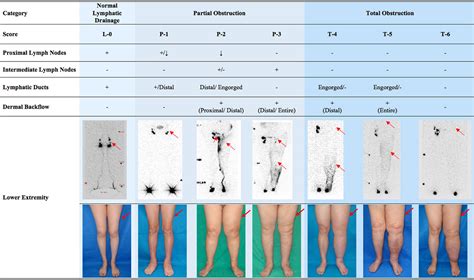 normal height for lymphedema